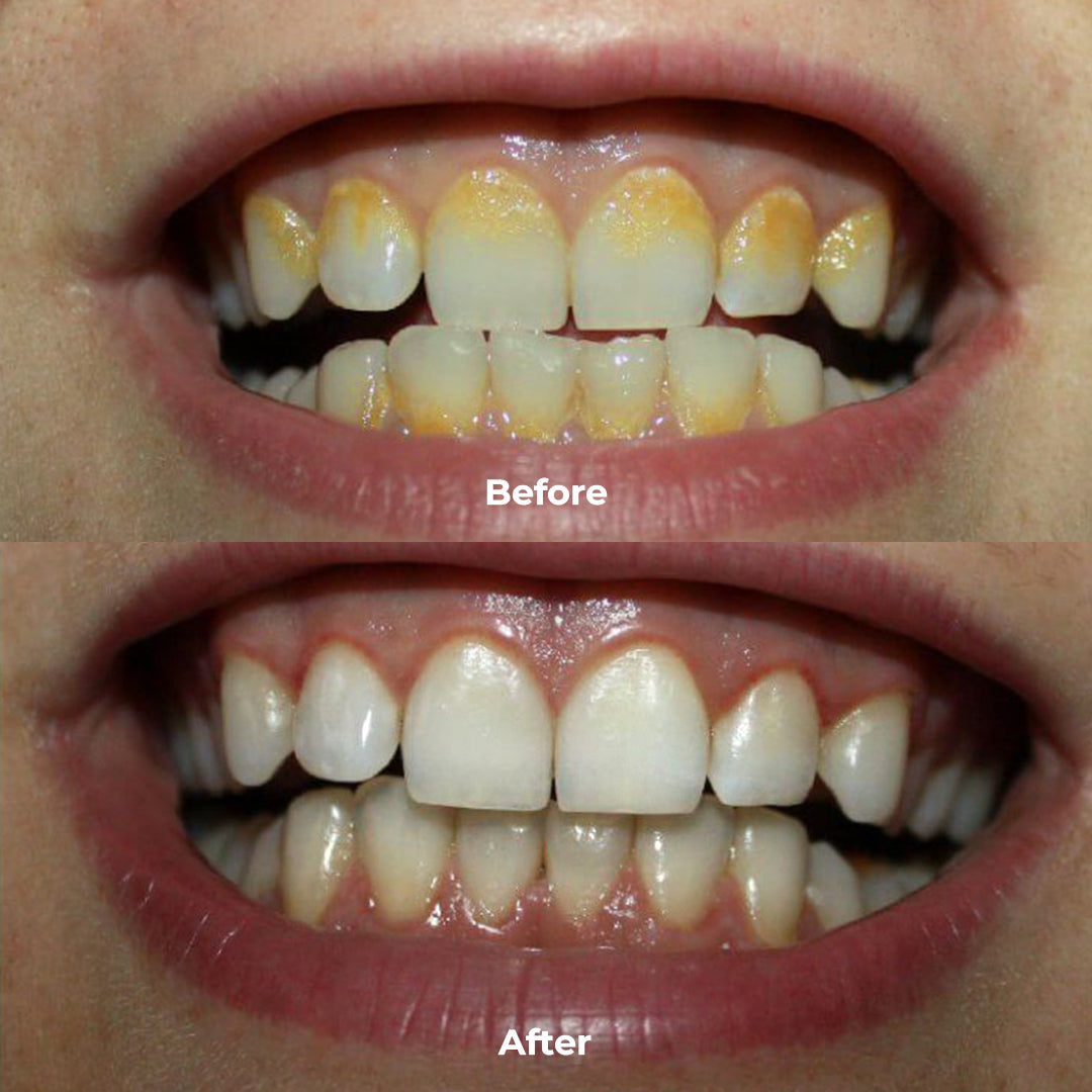 PUURSMILE WATER FLOSSER - 55% OFF HALLOWEEN SALE + 4 FREE GIFTS (WORTH $150)