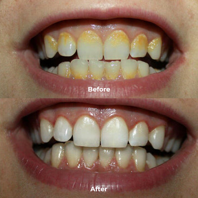 PUURSMILE WATER FLOSSER - 55% OFF HALLOWEEN SALE + 4 FREE GIFTS (WORTH $150)