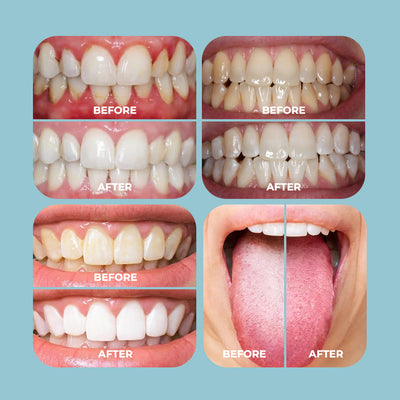 The MOTHER'S DAY Smile Reset System