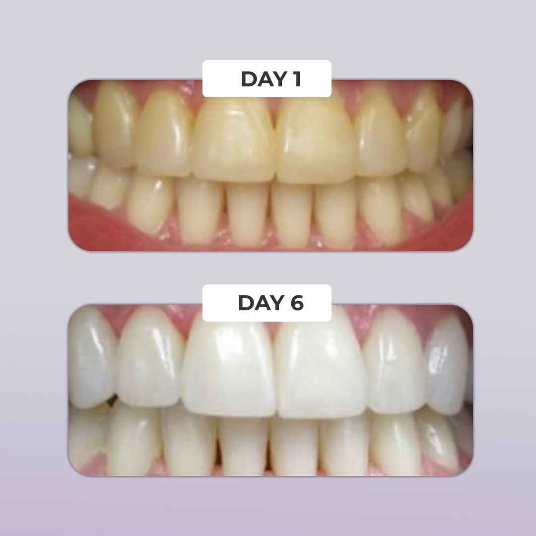 PUURSMILE TEETH WHITENING KIT - 50% OFF HALLOWEEN SALE