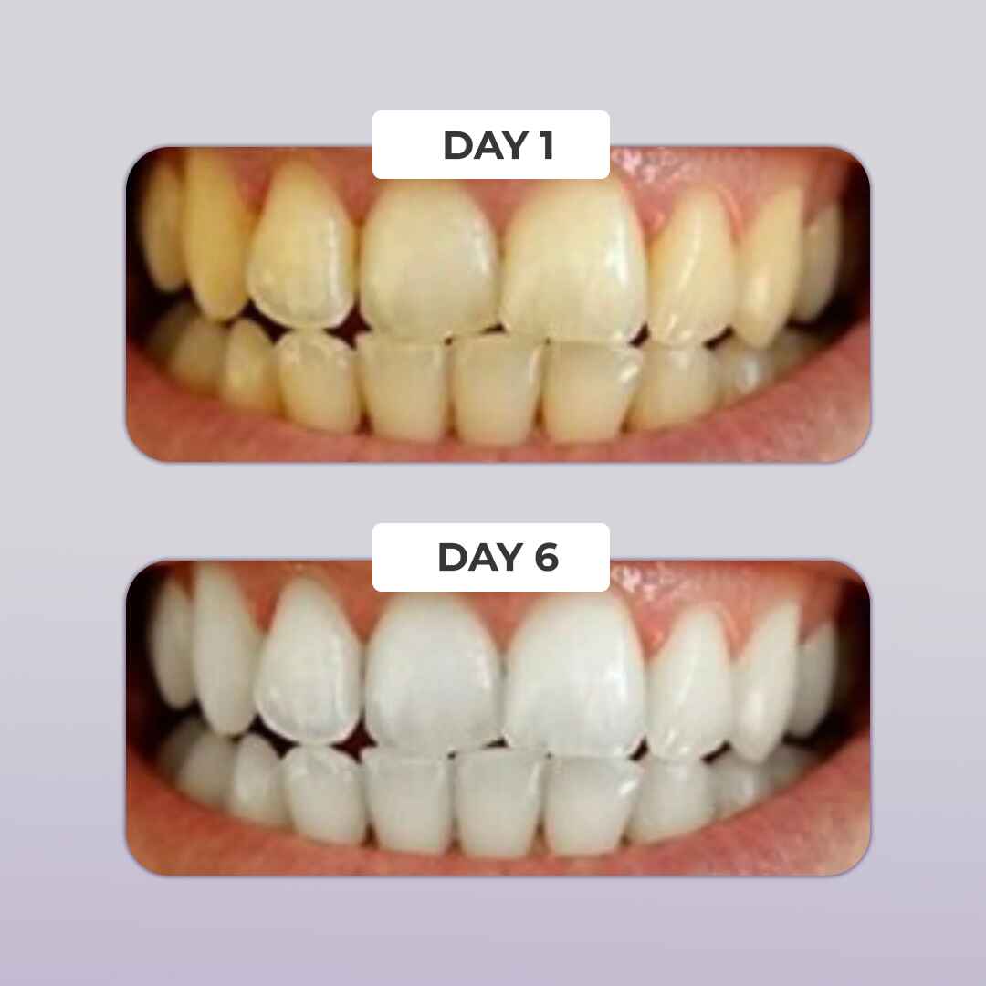 PUURSMILE TEETH WHITENING KIT - 50% OFF HALLOWEEN SALE