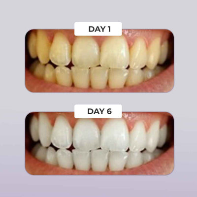 PUURSMILE TEETH WHITENING KIT - 50% OFF HALLOWEEN SALE