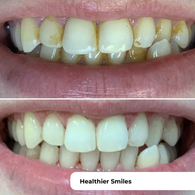 PUURSMILE WATER FLOSSER - 50% OFF HALLOWEEN SALE