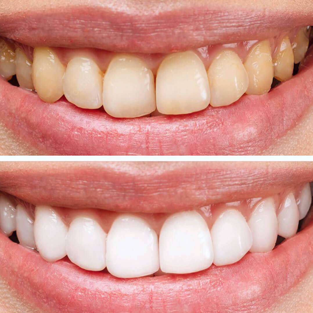 Teeth Whitening Kit (Preview Only)